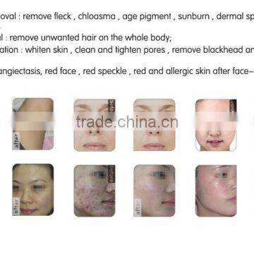 Ipl Shr Hair Removal Machine SHR Vertical Ipl Hair Removal System photo-3