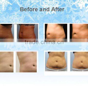 Cellulite Reduction FIve Handpieces Cryolipolysis Machine And Two Handpieces Can Work Together / Cryolipolysis Fat Freeze Slimming Machine Lose Weight photo-6