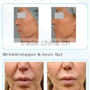 High Frequency Acne Machine 2015 New Products Ultrasound HIFU Machines Face Lift No Pain