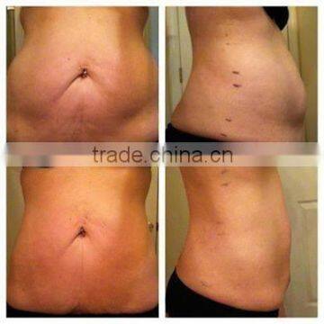 Cellulite Reduction Lipo Laser Machine/weight Loss Products Best Lipo Laser Machine