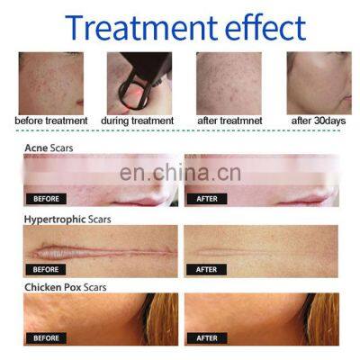 Fractional Co2 Laser Skin Resurfacing Co2 Fractional Laser Cost Medical Fractional Laser Co2 photo-5