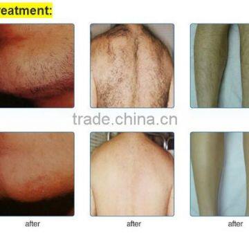 Best View IPL Hair Removal Machine for Skin Care Vascular Removal