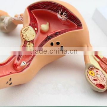 Human uterus and ovary vaginal pathological changes model of reproductive Department of gynecology medical demonstration model