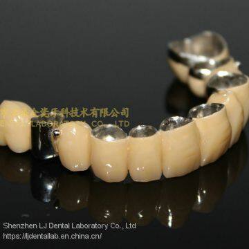 Dental Crown Composite, Dental Teeth, Dental Prosthesis, Laboratoire Dentaire, Dentallabor, Laboratorio Dental, Dental Laboratory, Shenzhen LJ Dental Lab China photo-4