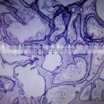 adamantoblastoma oral pathology prepared slides/teaching oral pathology slides/medical oral pathology slides