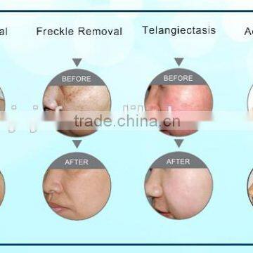 SK-11 Skin Rejuvenation Beauty Salon Equipment Luxury Hair Removal IPL