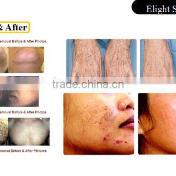IPL Laser Permanent Hair Removal Machine Manufacturer IPL