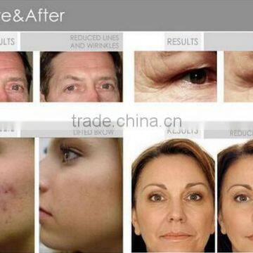 Ultrasonic Beauty Machine With High Frequency Vacuum Spray OL-3001A Apparatus photo-5