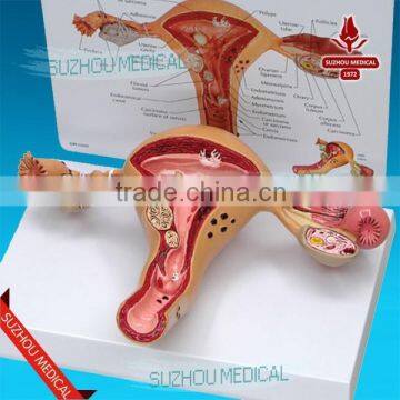 Pathology uterus model