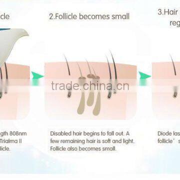The Best Permanent Laser Hair Removal Machine for Hair Removal photo-5
