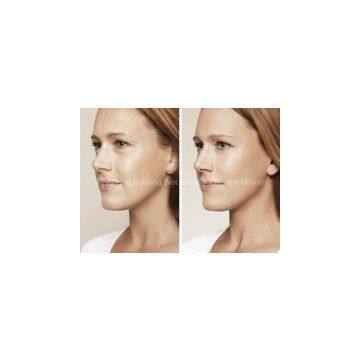 100%Pure Hyaluronic Acid Filler, Dermal Filler for Fine Line Wrinkle
