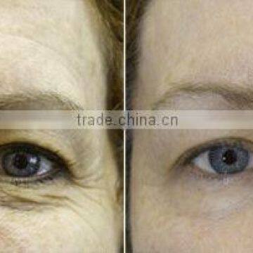 Skin Rejuvenation Wrinkle Removal RF Fractional Microneedle photo-6