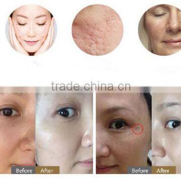 Best 755nm Laser Machine 3in1 Professional Multifunction POPIPL's 755nm Alexandrite Laser and Long Pulsed Laser 1064nm photo-5