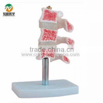 BIX-A1015 Human Osteoporosis Anatomical Model (3 Vertebrae) photo-2