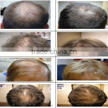 Best Selling Hair Loss Treatment Machine With CE Approved Laser Hair Growth Innovation 2016 photo-6