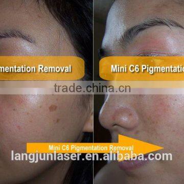 1-10Hz ND Yag Laser Modules / ND Yag Tattoo Removal Laser Equipment Laser Tattoo Removal Machine Tattoo Removal Laser Machine photo-2