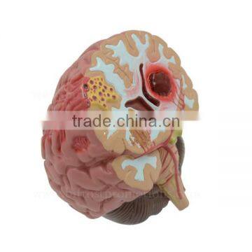 Organs Human Body Anatomy Brain Model Of Stroke photo-3