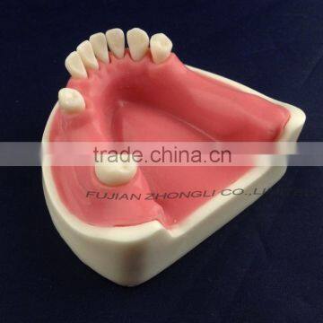 Medical Science Dental Implant Model With Soft Gingiva photo-3