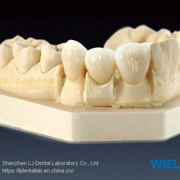 Wieland Zenostar Dental Crown, Solid Zirconia Bruxzir, Dental Teeth, Laboratoire Dentaire, Dentallabor, Laboratorio Dental, Dental Laboratory, Shenzhen LJ Dental Lab China photo-2