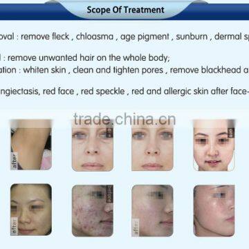 2016 Best Best Professional Vertical Palomar Laser IPL SHR E-light rf Hair Removal Equipment&machine for Sale photo-5