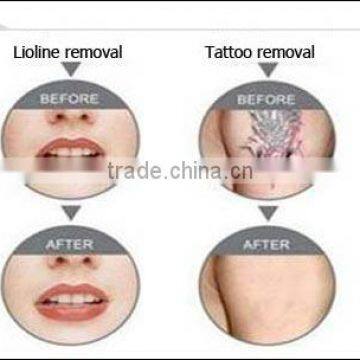 2016 Distributors Wanted 1500mj Medical eo Active q Switched nd Yag With CE photo-6