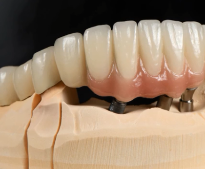 Dental Crown and Dental Bridge - Metal / Pfm / Ceramic Bridges