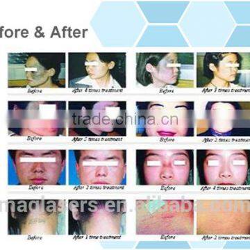 Wart Removal Low Price Multifunctional Co2 Laser Fractional Machine/laser Clinic And Medical Uses Vaginal Rejuvenation photo-6