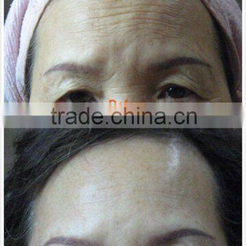 Non-surgical No-wound Hifu Anti-aging Face Lift Machine With 3 Cartridge Different Treatment photo-3