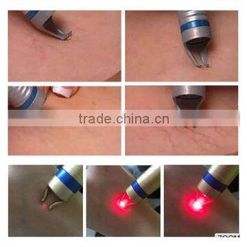 Permanent Remove Vascular Machine by 980nm Diode Laser photo-4