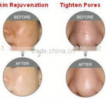 Woman Beauty Machine RF Fractional CO2 Laser Carboxytherapy Vaginal Tightening And Rejuvenation Treatment With Medical CE Skin Tightening photo-2