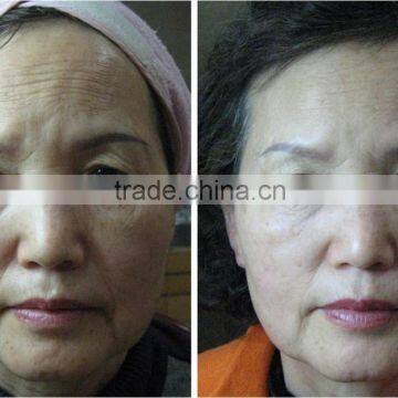 Anti-wrinkle And Anti-aging Machine Type and Ultrasonic Operation System HIFU Face Lift Machine photo-4