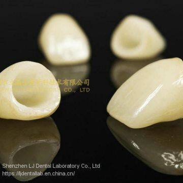 Dental Crown E.Max Ceramic, Porcelain Crown, Dental Veneers, Laboratoire Dentaire, Dentallabor, Laboratorio Dental, Dental Laboratory, Shenzhen LJ Dental Lab China photo-2