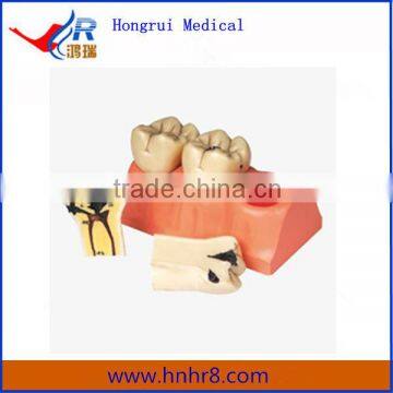 Hot Sale Dissected Model of Dental Teeth Caries