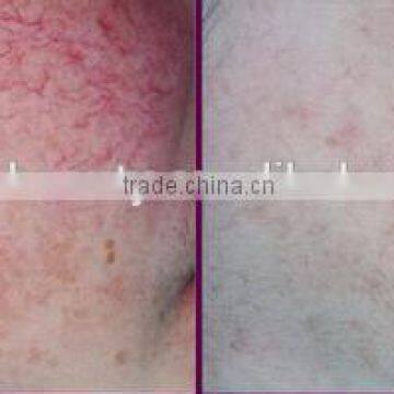 Professional Vascular Vein Stopper 980nm Varicose Veins Removal Diode Laser photo-5