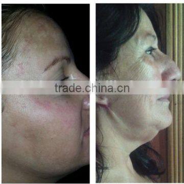 Beauty Equipments Skin Tightening Portable Face Lift Radio Frequency photo-5