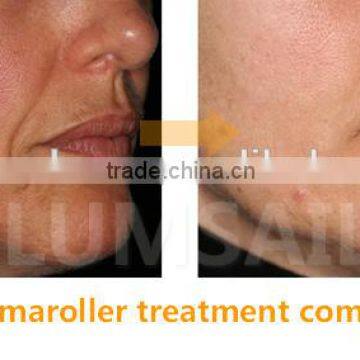 3 in 1 Derma Roller Dermaroller for Treatment of Acne Scars and Healing Wounds