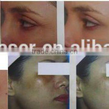 2015 30W RF Tube CO2 Fractional Laser for Scare Removal