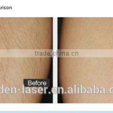 Factory Sale 808 Diode Hair Removal photo-4