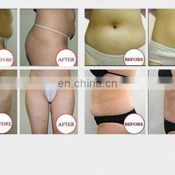 Popular Fat Freezing /cryolipolysis Slimming Machine/criolipolisys Machine photo-3