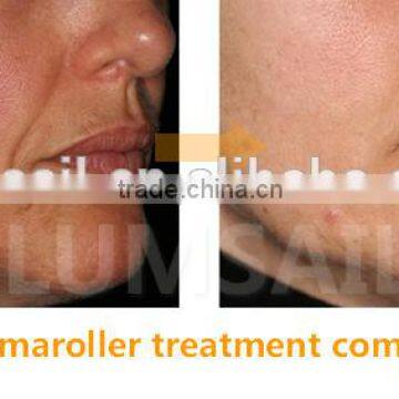 New 2016 Skin Care Derma Roller Dermaroller for Acne Removal Beauty Equipment photo-4