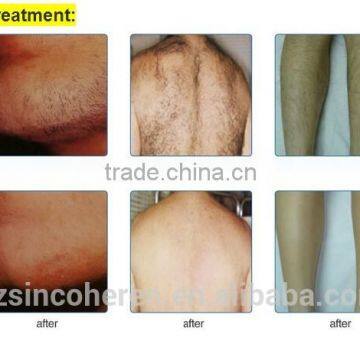 Sincoheren FDA CE Approved Hair Removal Machine,OPT FP Technology NYC-3 photo-4