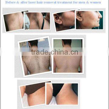 Hot China Products Portable Medical Beauty Soprano Laser Hair Removal Machine