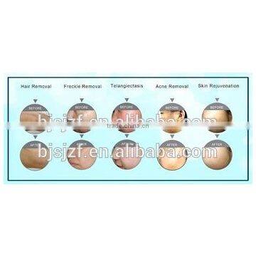 IPL-C IPL Hair Removal Equipment Ipl Hair Removal Machines Home Use