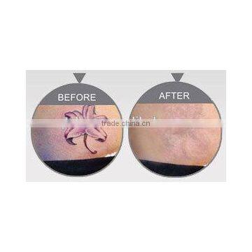 Competitive Q Switch Nd Yag Laser Tattoo Varicose Veins Treatment Removal Laser Machines Naevus Of Ota Removal photo-3