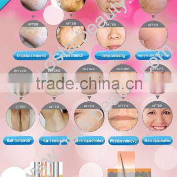 rf Lifting Beauty Machine Ostar Beauty CE and ISO Approval RF 03 photo-6