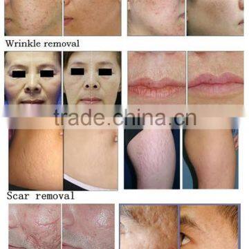 30W RF Mental Tube CO2 Laser Portable Fractional Acne Scar Removal Machine Professional photo-3