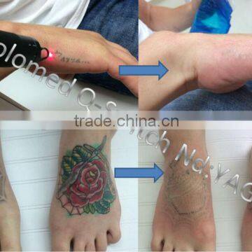 Tattoo Removal Laser 1064nm Yag Laser Beauty Equipment (CE1023,ISO13485) photo-3