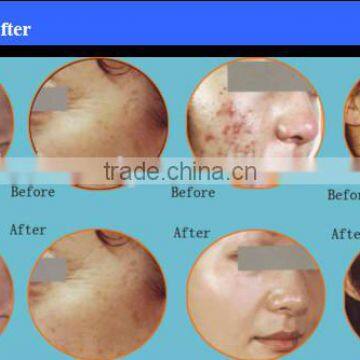 Acne Removal/freckle Removal/co2 Fractional Laser+CE Certification+factory Price photo-6