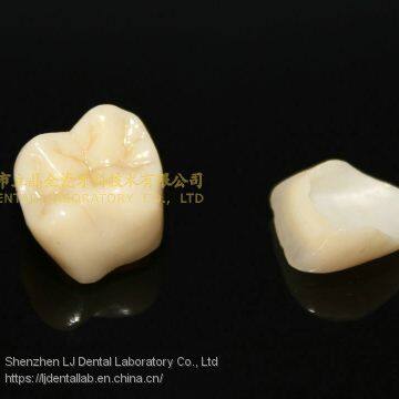 Dental crown zirconia PFZ, dental teeth, dental prosthesis, laboratoire dentaire, Dentallabor, laboratorio dental, dental laboratory, Shenzhen LJ dental lab China