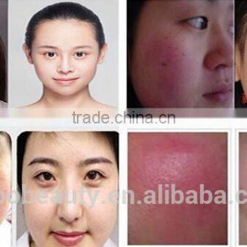 Beauty Cosmetics Laser Vascular Removal 980nm Diode Laser Spider Vein Removal Machine photo-6